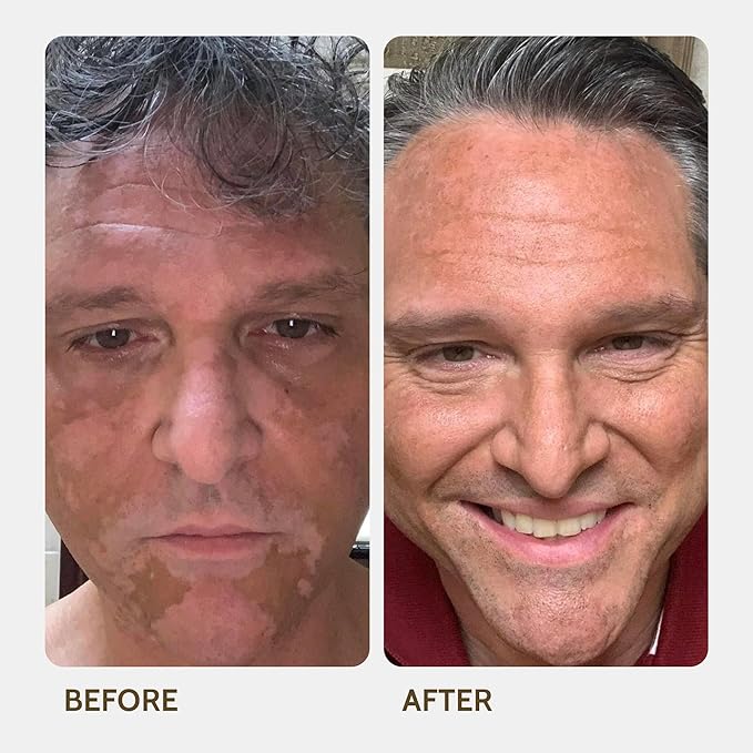 Vitiligo Vanquish Cosmetic Camouflage Kit by Fake Bake Liquid Concealer, Long Lasting Natural Color Customization Eliminates Appearance of Skin Depigmentation For Women & Men - Cover Lasts For Days