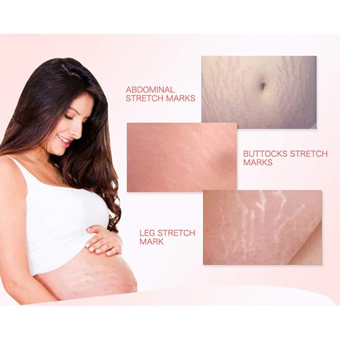 AICHUN BEAUTY Pregnancy Cream Streach Mark Remover Scars Repair Cellulites Lotion Cream 150ml