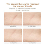Acne Scar Removal Cream Stretch Marks Face Skin Cream Shrink Pores Gel-Fade Scar Marks Acne Skin Care (Packaging Upgrade) VeniCare