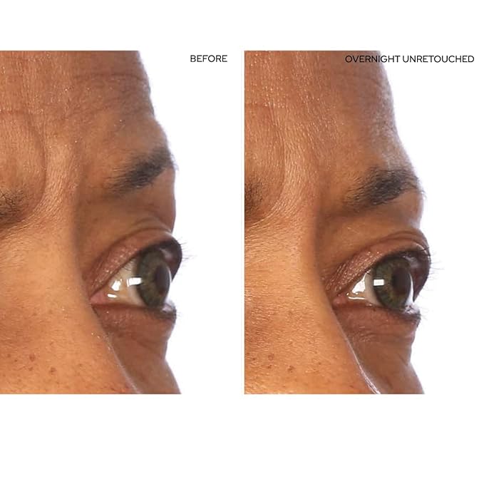 Sio beauty superlift forehead, eye,