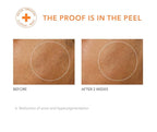 Dr. Dennis Gross Alpha Beta Universal Daily Peel: for Uneven Tone or Texture and Fine Lines or Enlarged Pores, (5 Treatments)