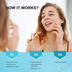 Acne Pimple Spot Treatment Cream: Cystic Hormonal Blackheads Blemish Remover for Face, Back and Body - with 10% Azelaic Acid - Teens 13-19 & Young Adult 20-30, 1.8 oz