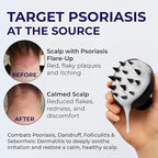 Scalp Psoriasis Shampoo, Flakes Shampoo Anti Dandruff, Itchy Scalp Treatment for Seborrheic Dermatitis & Folliculitis, Anti Fungal, Medicated Solution for Itchy, Flaky & Dry Hairs