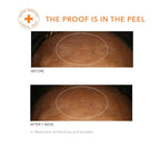 Dr. Dennis Gross Alpha Beta Universal Daily Peel: for Uneven Tone or Texture and Fine Lines or Enlarged Pores, (5 Treatments)