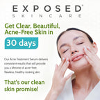 Exposed Skin Care Acne Treatment Serum Step 3 – Quickly Reduces Pimple Size and Redness - 12 Hour Spot Treatment - 3.5% Benzoyl Peroxide, Natural Green Tea & Tea Tree Oil