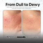 5% Lactic Acid + 2% Salicylic Acid Cleanser –Non-Stripping AHA/BHA Exfoliating Face & Body Wash With Ceramides. Minimizes Pores, Keratosis Pilaris, Acne, Ingrown Hairs & Psoriasis-200ml.