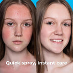 Hypochlorous Acid Spray (8oz, Reduces Acne), Targets Bacteria - HOCL Facial Cleanser Acne Spray for Face, Body, Eczema, Pimples, Breakouts & Overall Skin Recovery (Reduces Redness)