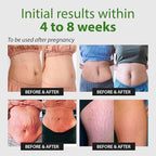 Abera Ovela Maternity Stretch Mark Cream for Pregnancy and Weight Fluctuations, Stretch Mark Treatment Pregnancy Must Haves, Deep Stretch Mark Removal, All Skin Types, 1.69 fl oz, Set of 3