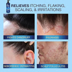 Anti-Fungal Shampoo for Scalp Psoriasis: Dandruff Shampoo for Folliculitis and Seborrheic Dermatitis - Relieves Itchy & Dry Scalp - 300 mL / 10.1 fl.oz