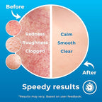 Hypochlorous Acid Spray (8oz, Reduces Acne), Targets Bacteria - HOCL Facial Cleanser Acne Spray for Face, Body, Eczema, Pimples, Breakouts & Overall Skin Recovery (Reduces Redness)